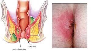 آبسه مقعدی | علل، علائم، تشخیص و درمان